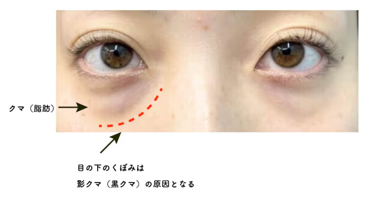 こだわりを持って行われる脂肪注入