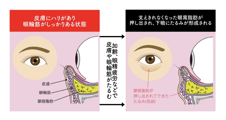 クマの原因は「目袋３脂肪」