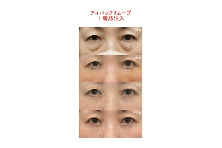 表を切るクマ取り（アイバックリムーブ・切開ハムラ）