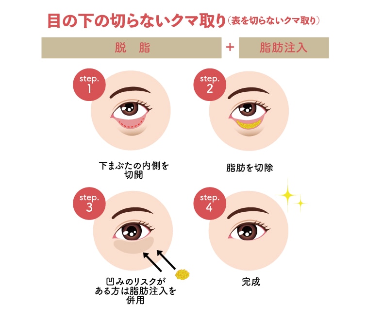 目の下の切らないクマ取り（表を切らない方法）
