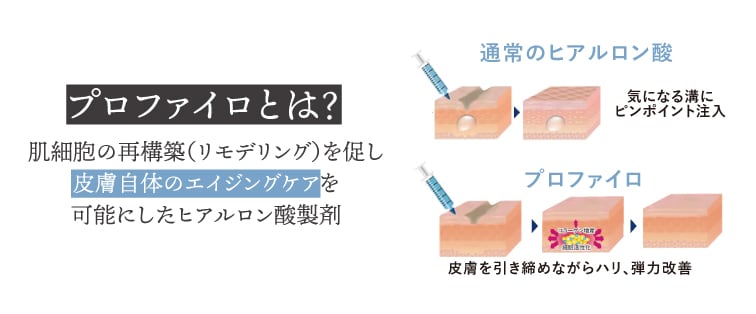 プロファイロとは？