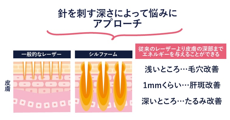 針を刺す深さによって悩みにアプローチ