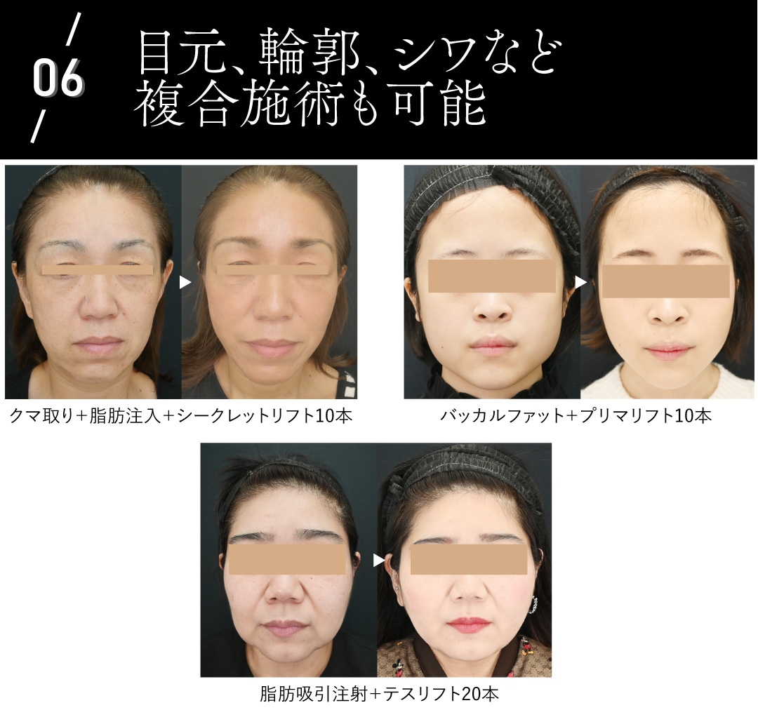 目元、輪郭、シワなど複合施術も可能