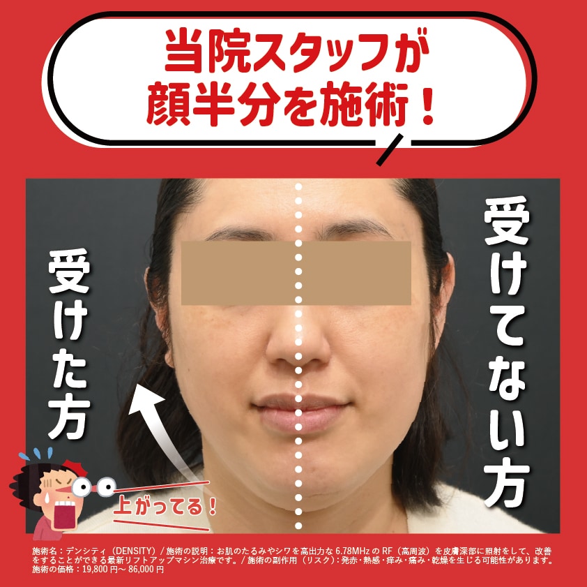 船橋院のスタッフが半顔だけ受けてみました！