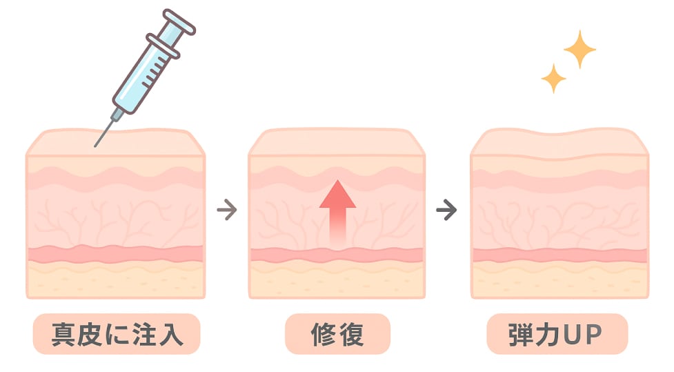 “肌の再生注射”<br />
