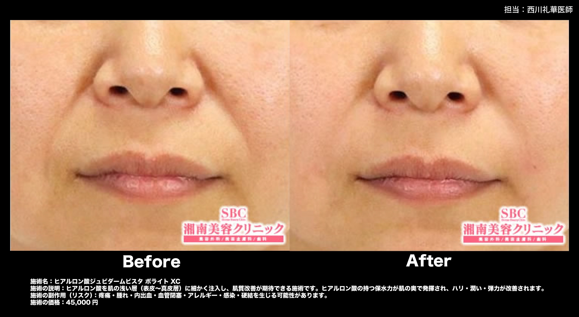 ②ヒアルロン酸