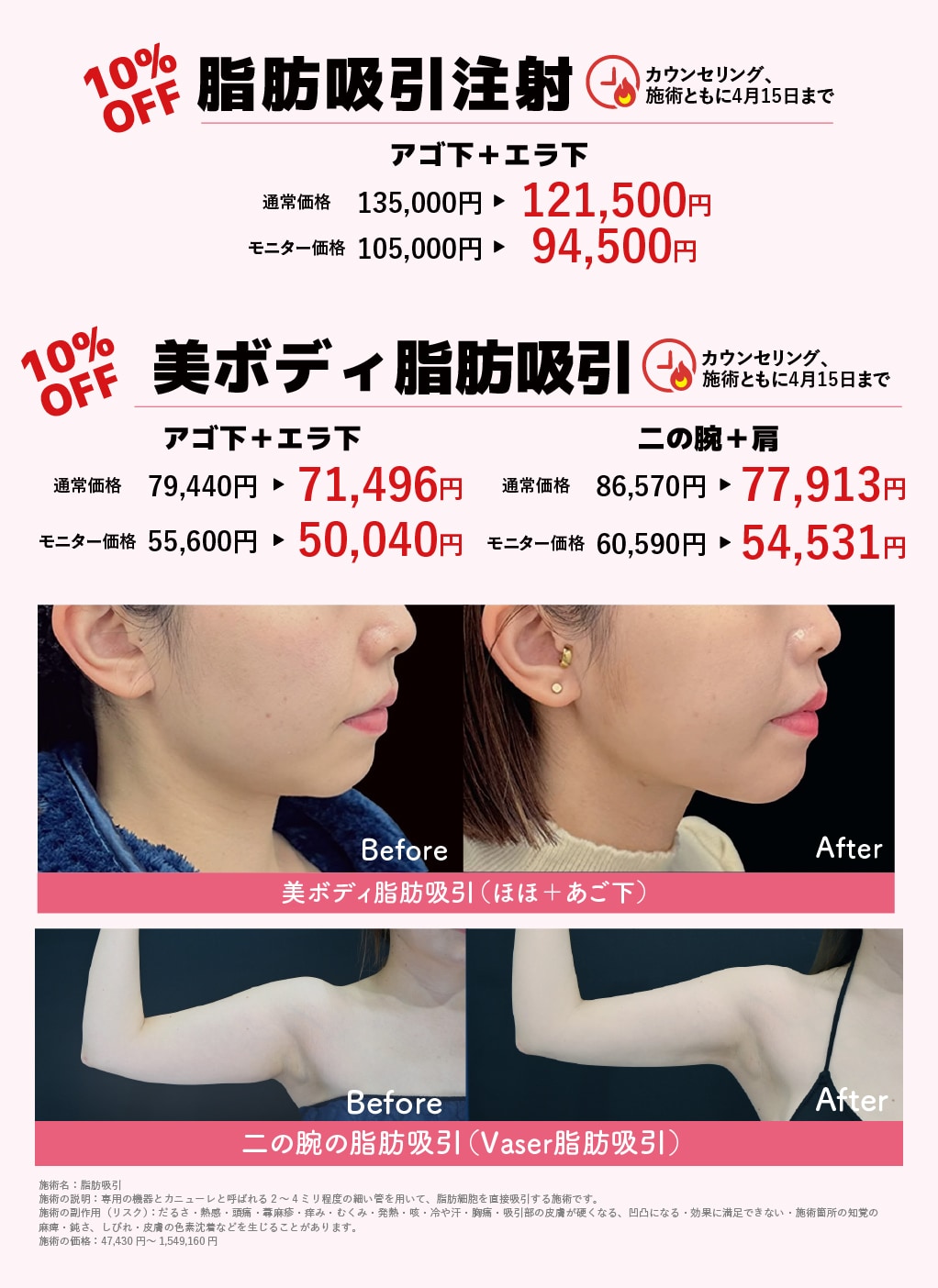 脂肪吸引キャンペーン | 湘南美容クリニック船橋院