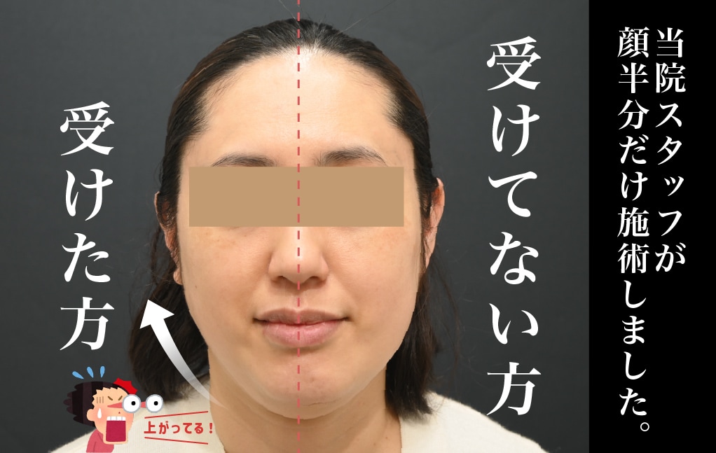 デンシティモニター症例 | 湘南美容クリニック船橋院