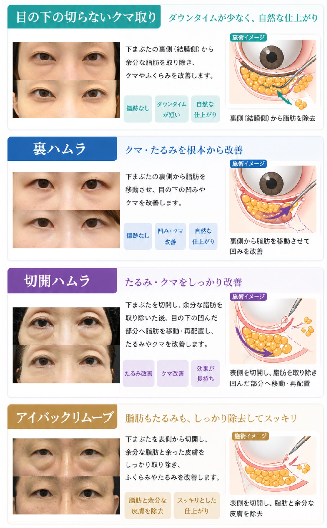 船橋エリアで注目の「切らないクマ取り」から「ハムラ法」までの定義
