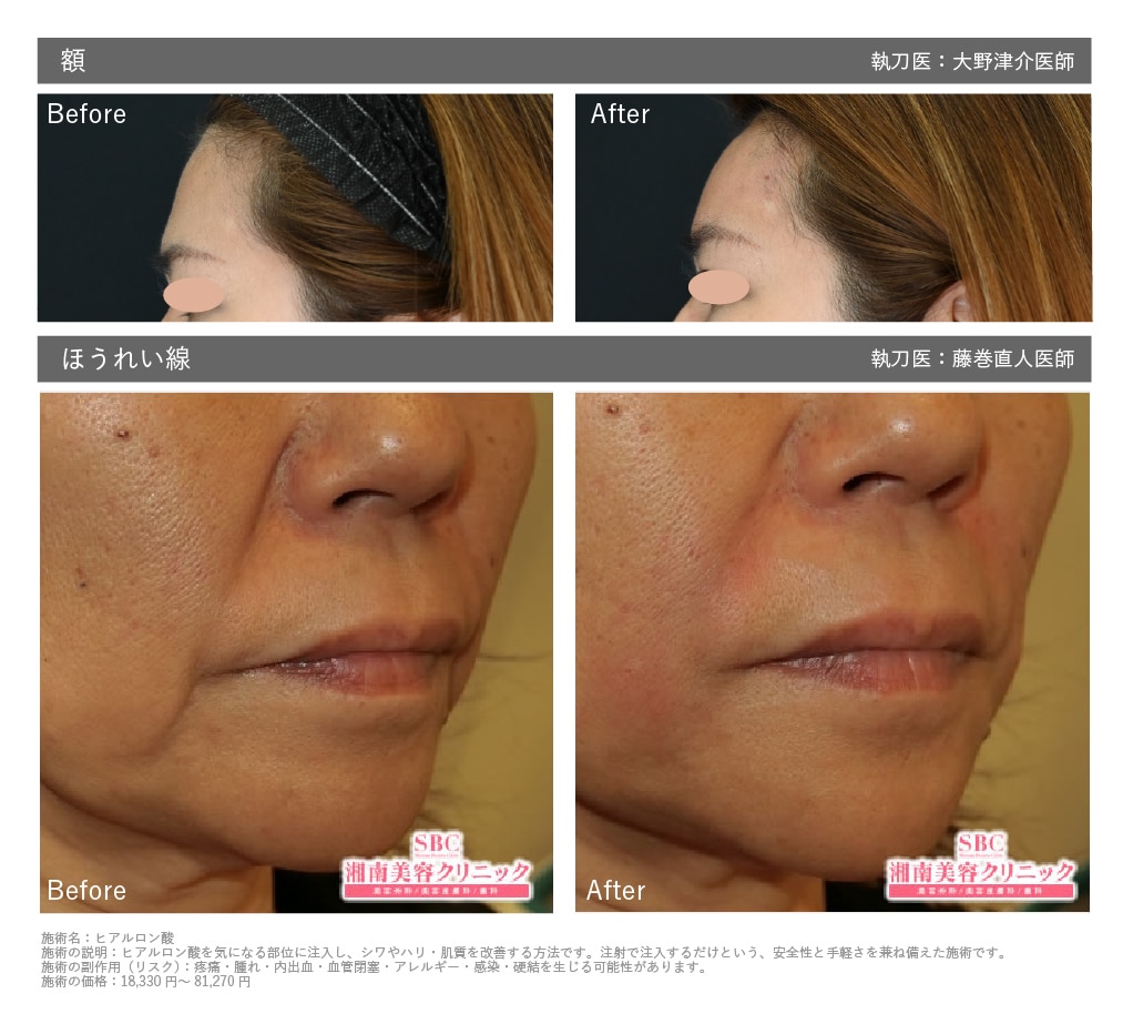 ヒアルロン酸症例 | 湘南美容クリニック船橋院