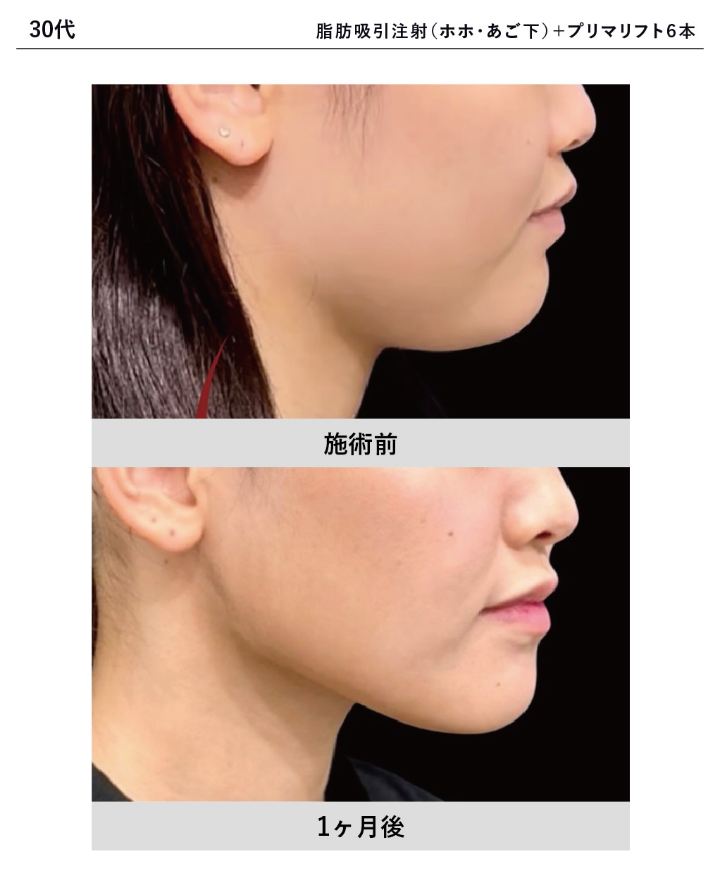 脂肪吸引注射×糸リフト症例写真