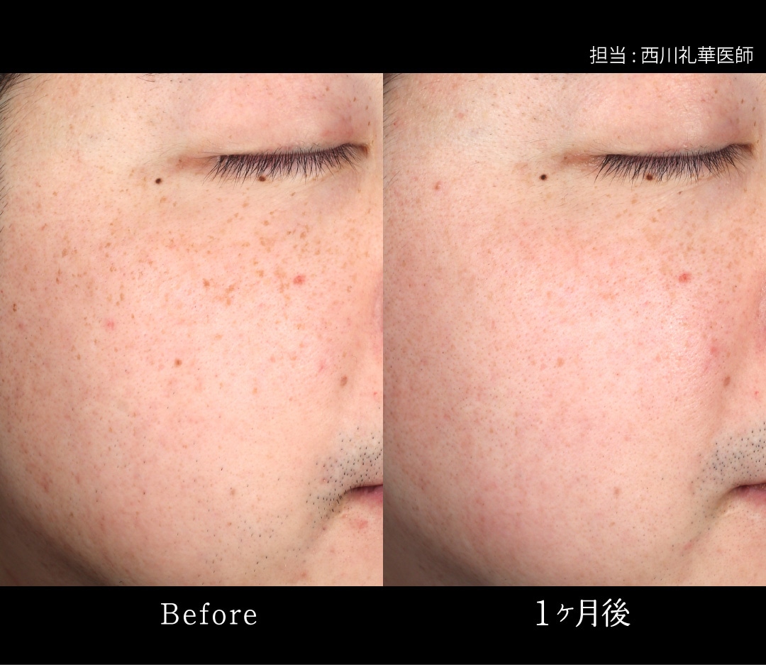IPL光治療 症例写真