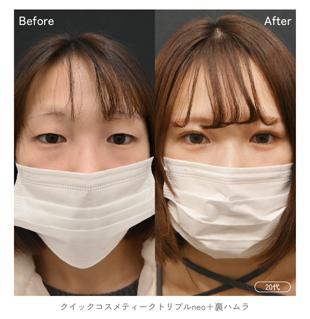 「二重×クマ取り」人生が変わるほどの変化量！