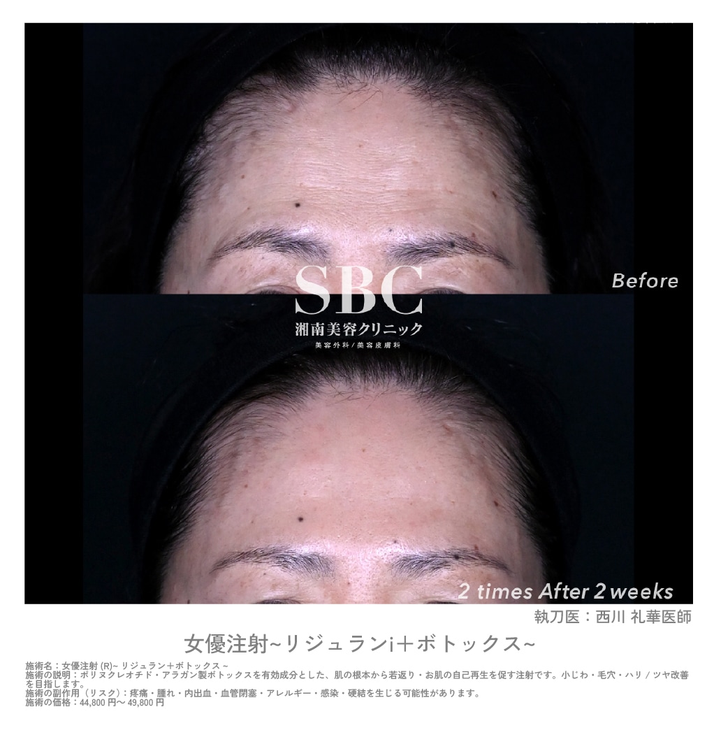 女優注射症例 | 湘南美容クリニック船橋院
