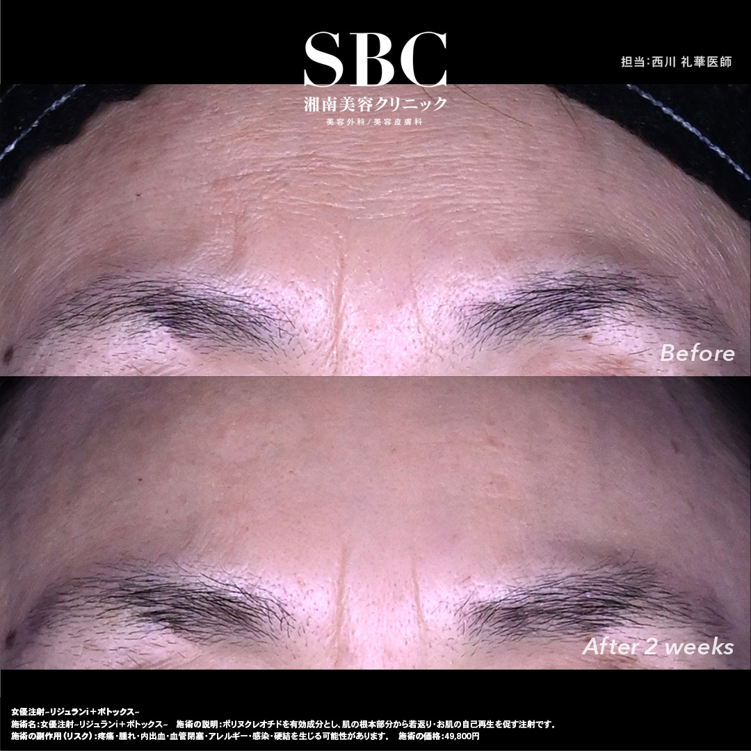 女優注射(額)症例