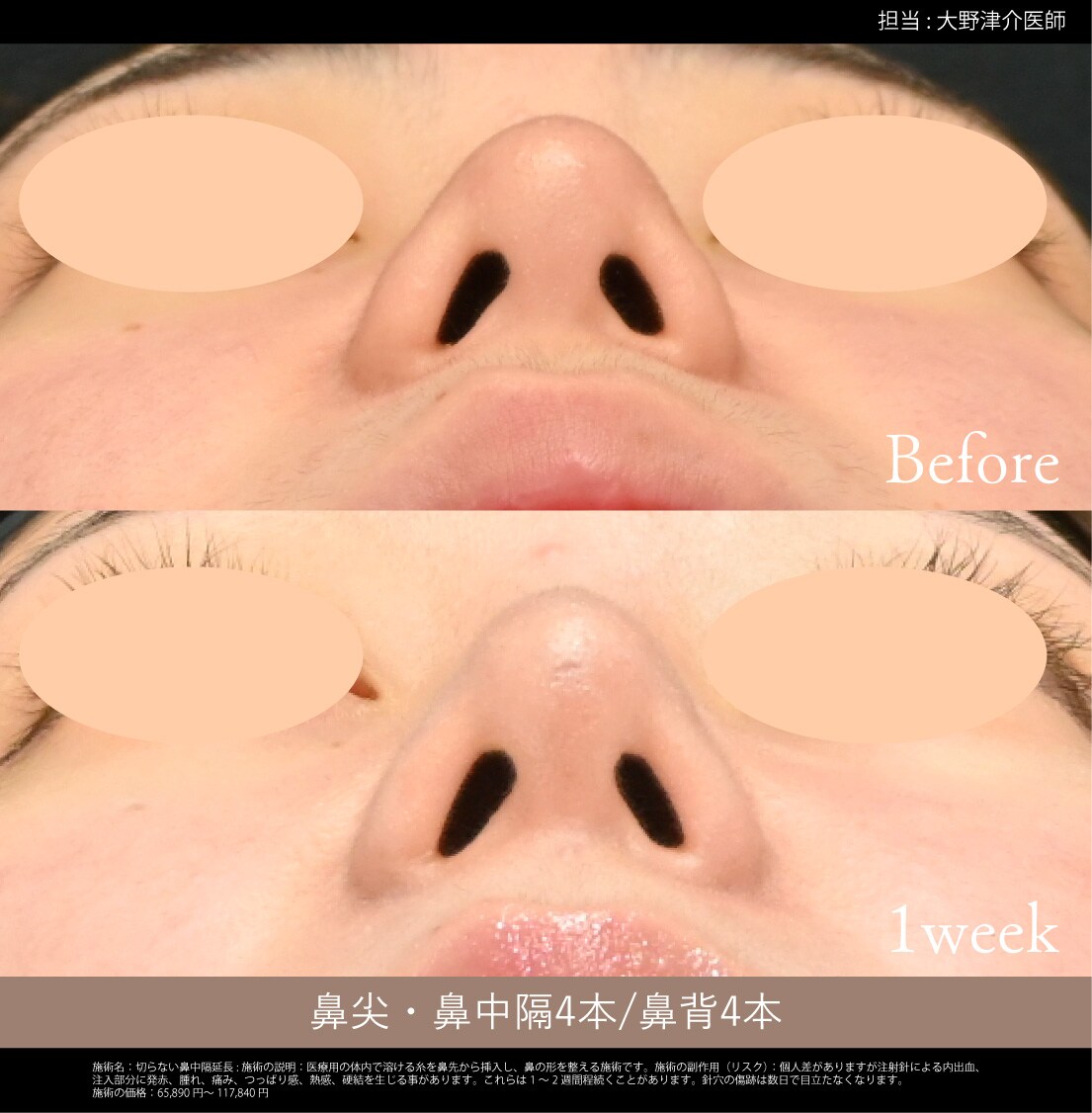 テスリフトノーズ 症例写真