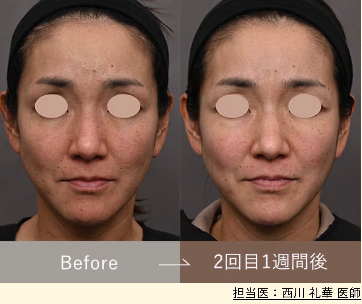 まずは【プロファイロ・ストラクチュラ】の効果をご覧ください✨