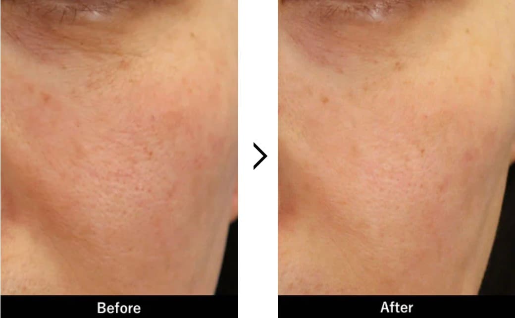 イオン導入【ベビースキン】