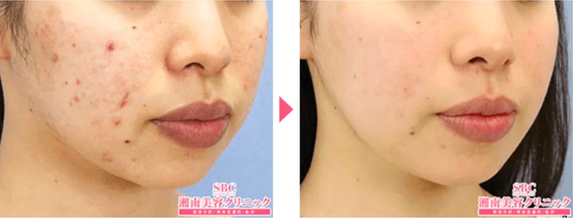 ケミカルピーリング