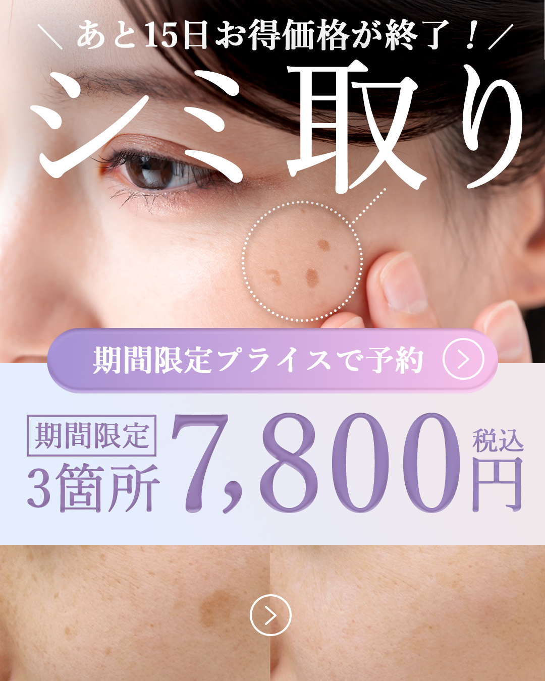 【残り15日⚠️】新春SALE限定《シミ取り22%OFF》の予約枠が埋まり始めています🚨▶︎