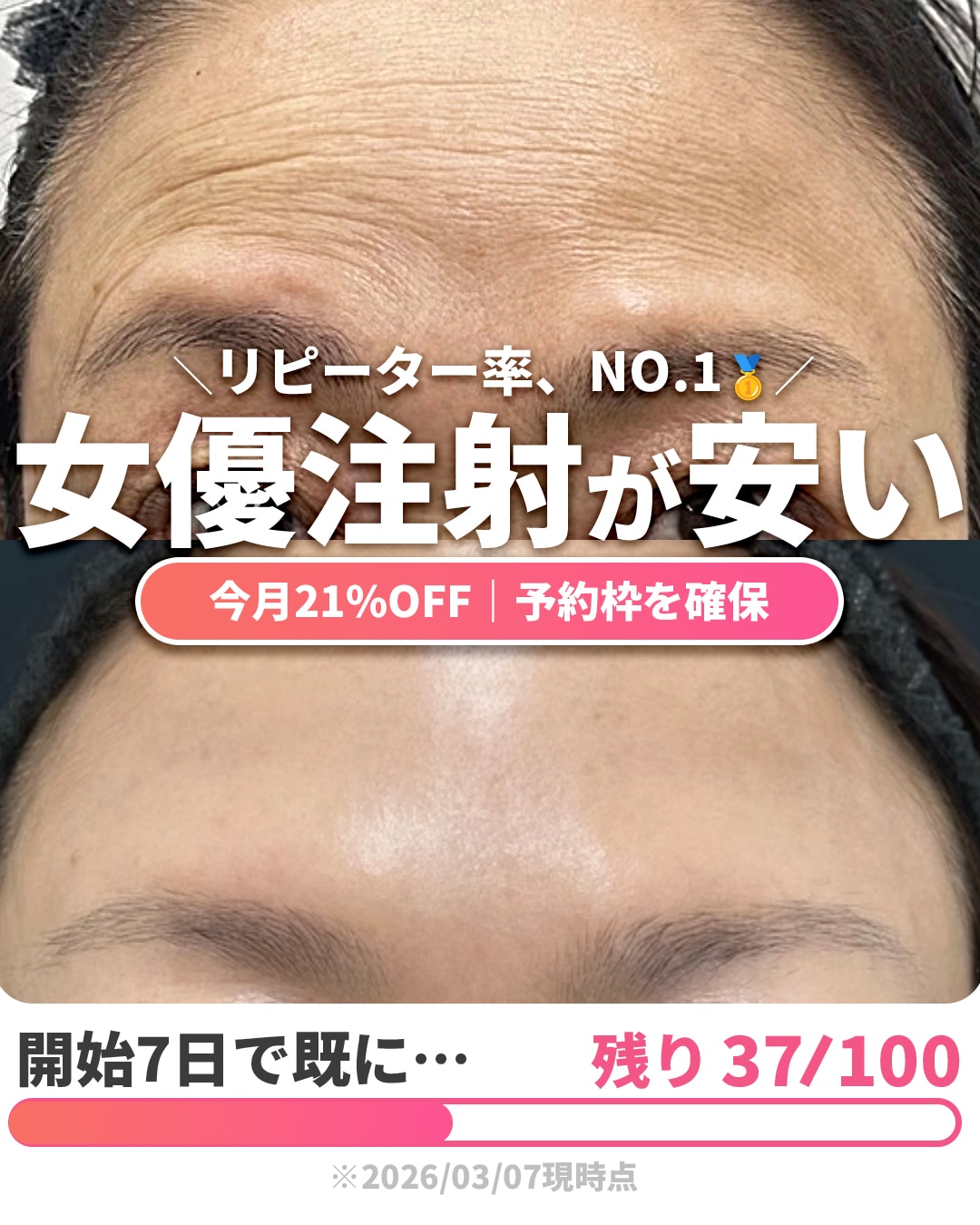 「小ジワ・毛穴が1ヶ月で消えた…😳⁉️」3月はリピーター率No.1🥇の〇〇注射がお得✨