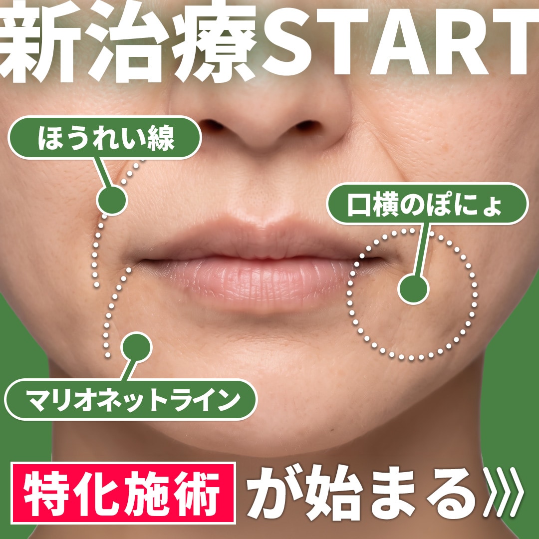 ぽにょぴたスレッドで、ほうれい線・口横のぽにょ・マリオネットライン解消‼️【新治療✨9/1-START】