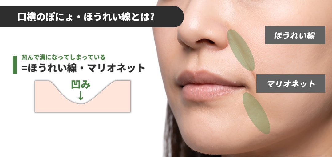 そもそも【口横のぽにょ・ほうれい線】とはどういう状態？