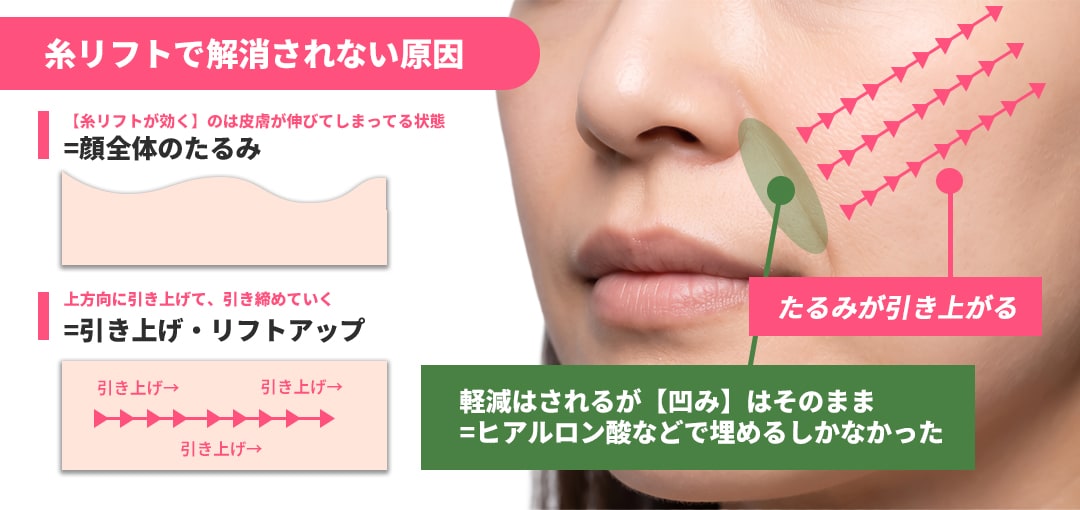 糸リフトでは解消されない原因