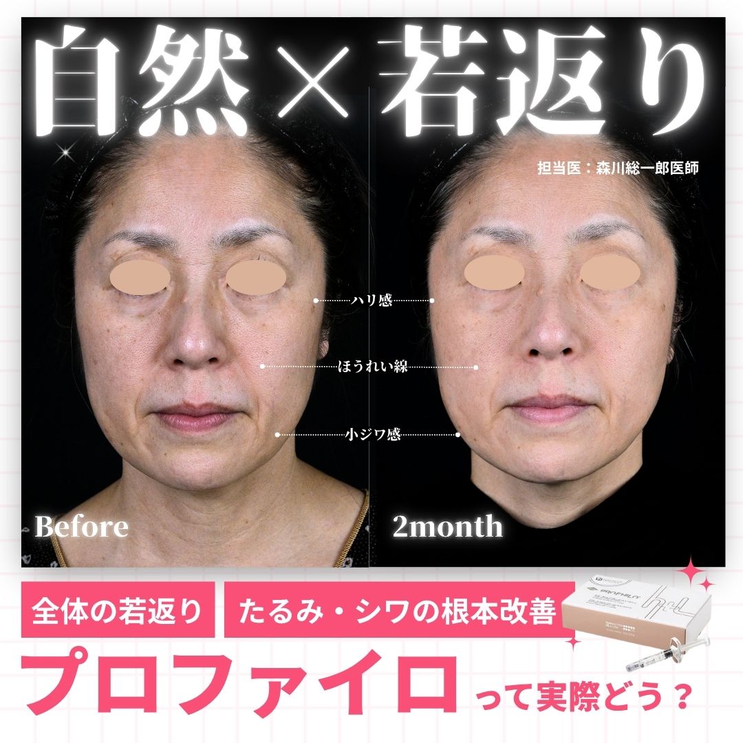 【肌育01】プロファイロで叶える「自然×若返り」｜効果や効果持続期間・痛みまで解説