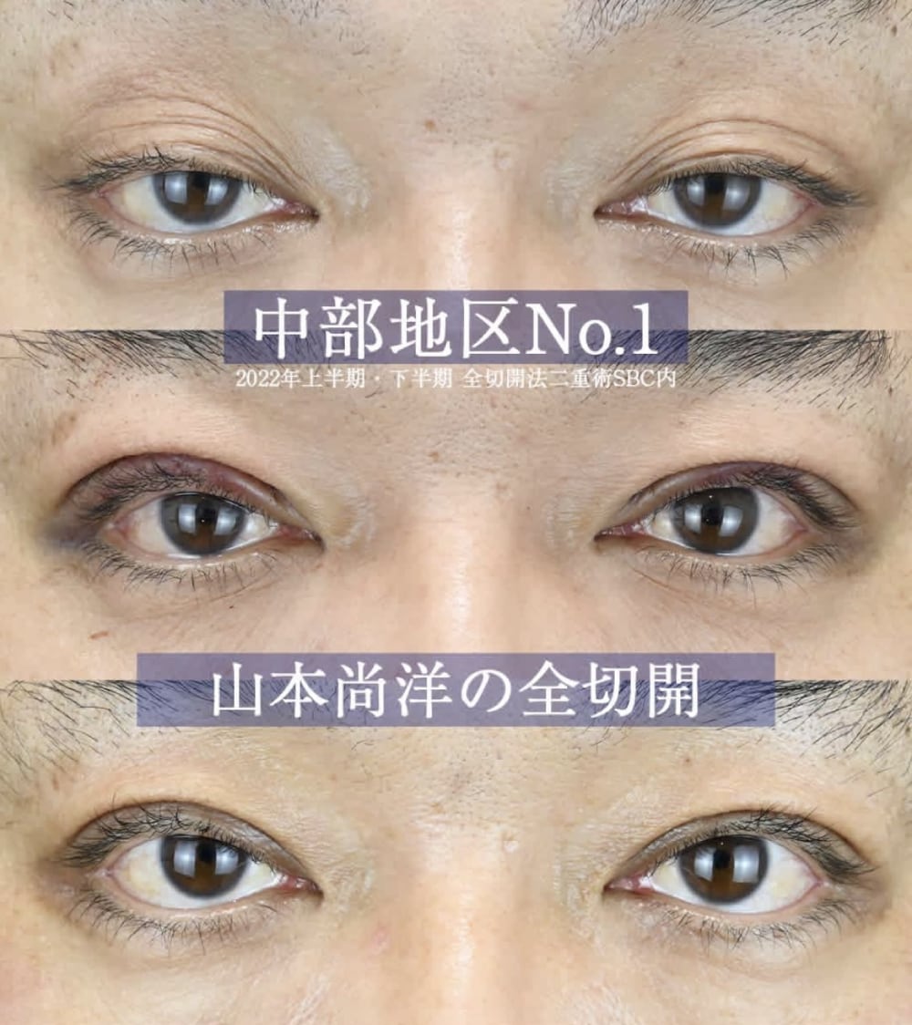 たるみ取り併用全切開法二重術+眼瞼下垂術