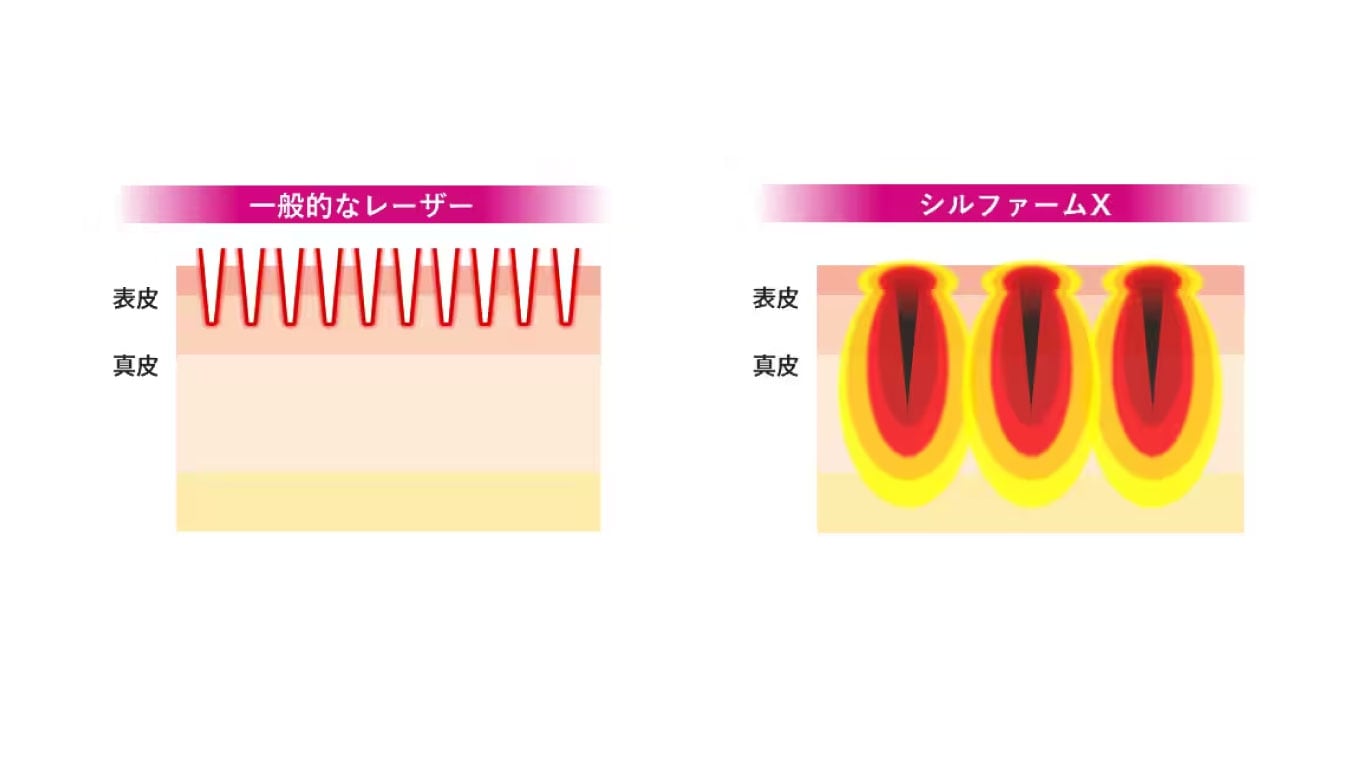 普通のレーザーと何が違うの？