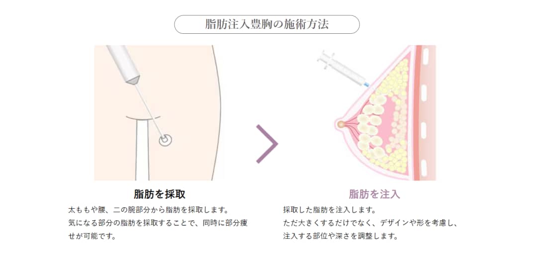 脂肪豊胸で自然な仕上がり