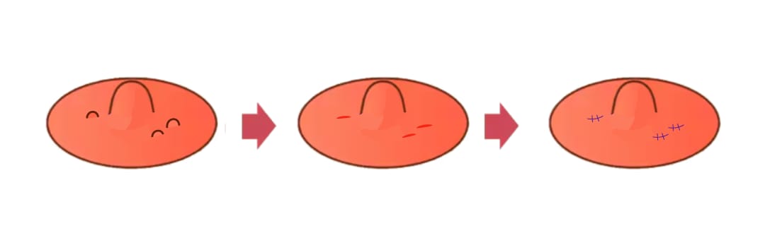 モントゴメリー腺切除