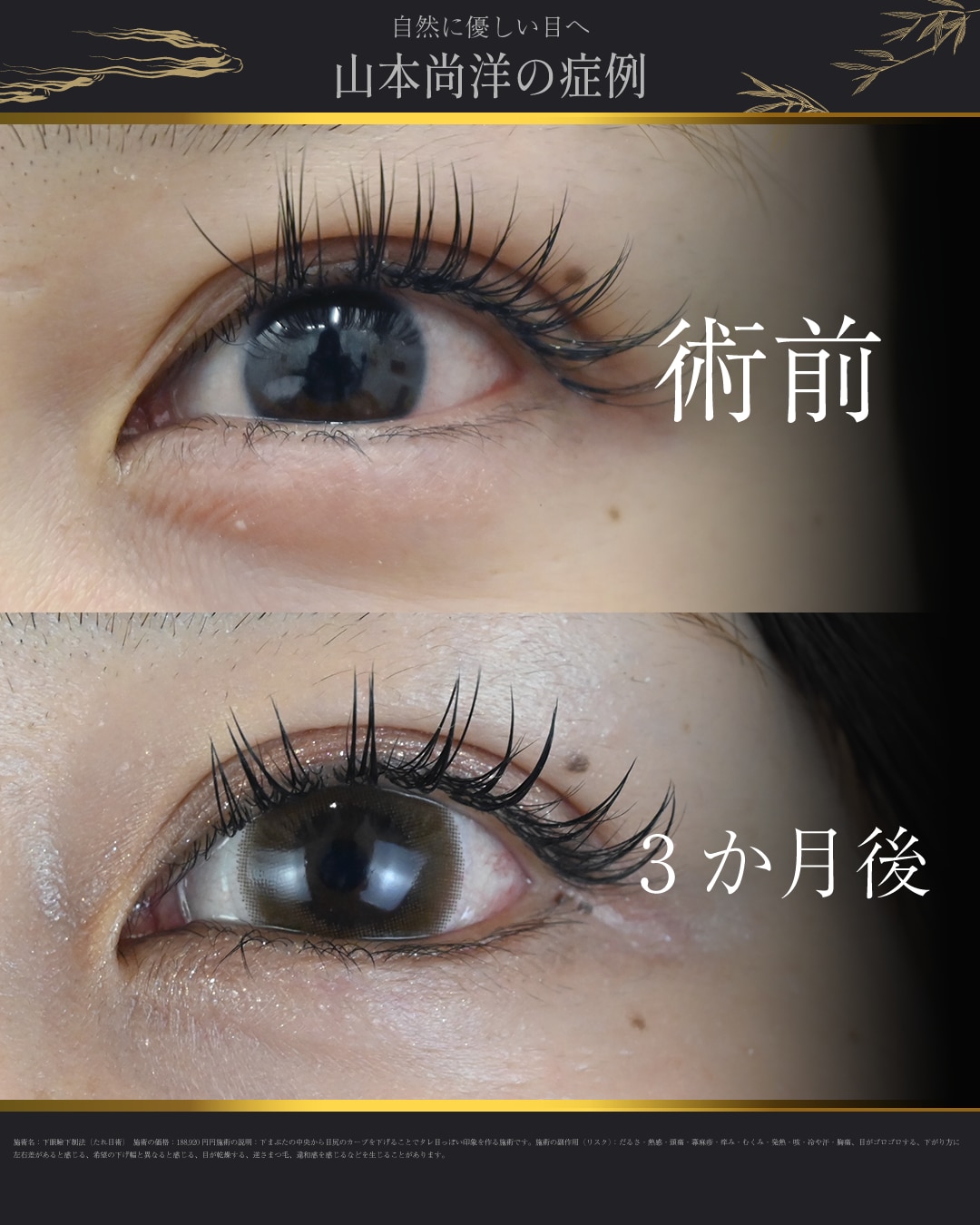 下眼瞼下制（結膜切開）
