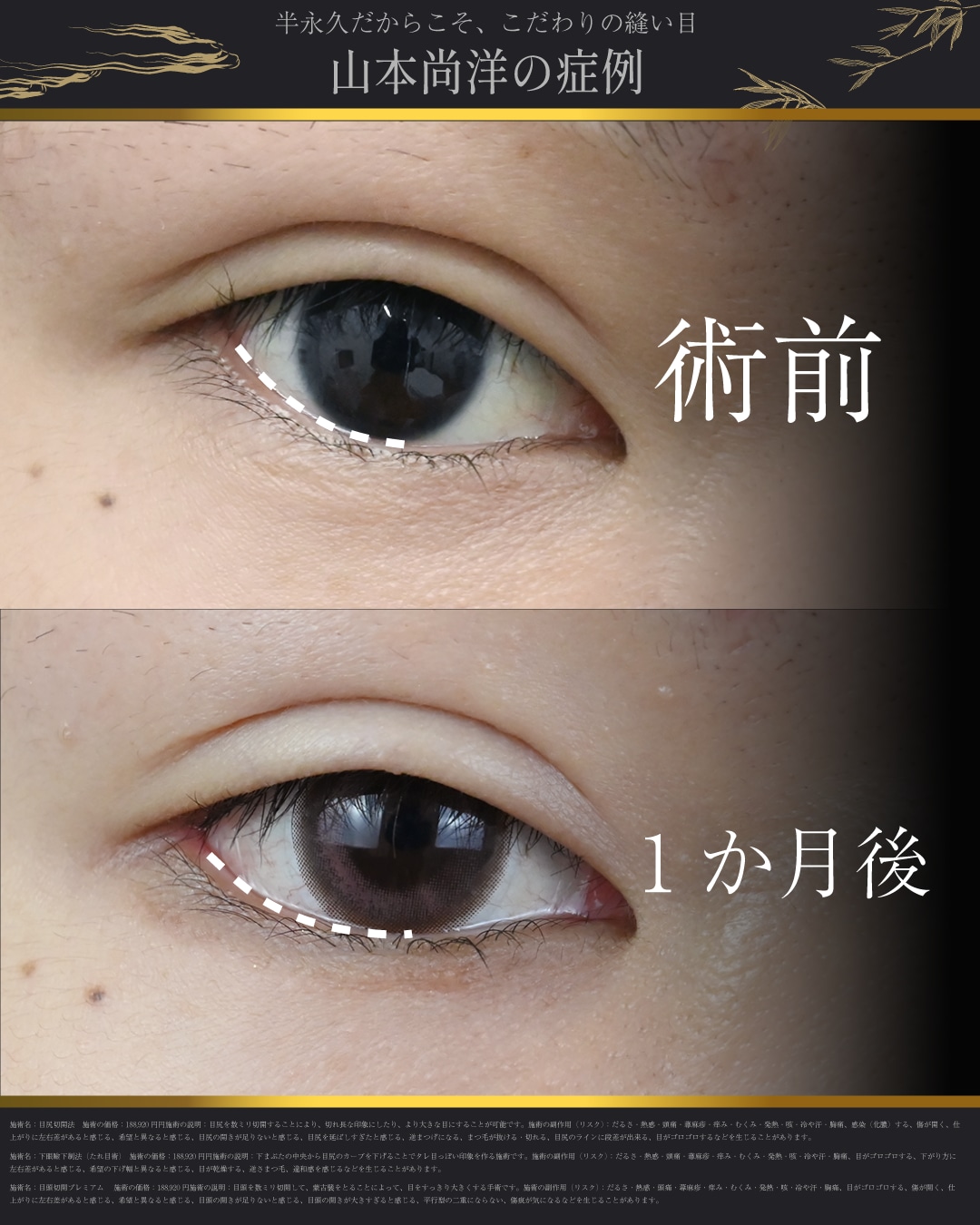 目尻切開＋下眼瞼下制（皮膚切開）