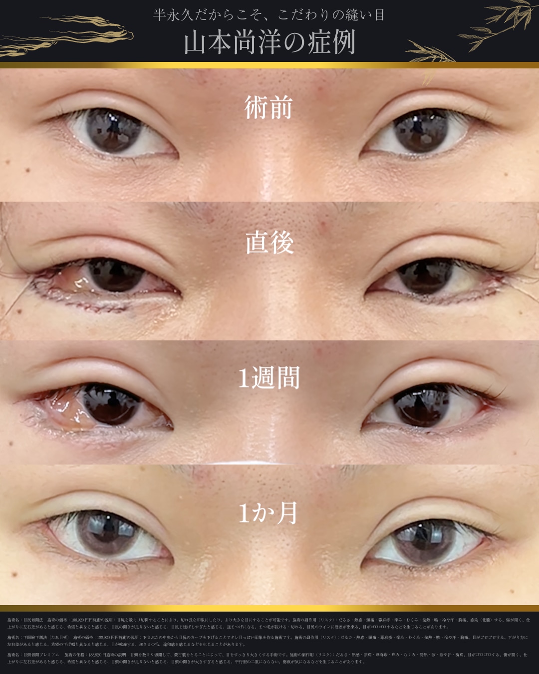 目尻切開＋下眼瞼下制（皮膚切開）