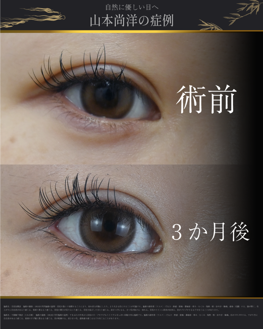 目尻切開＋下眼瞼下制（結膜切開）