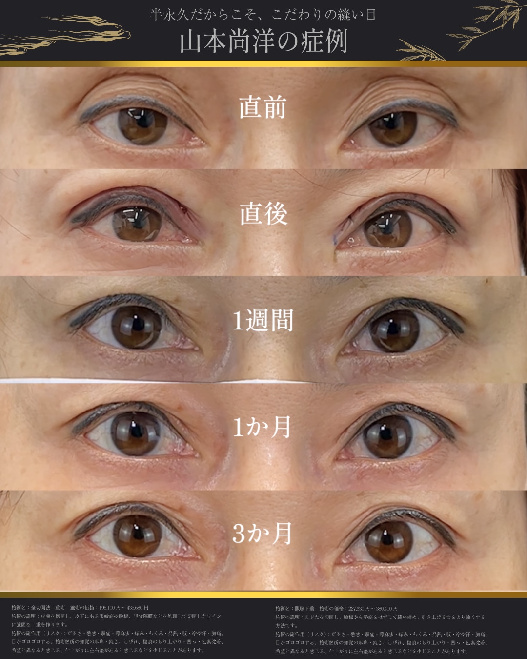 眼瞼下垂術＋たるみ取り併用全切開術