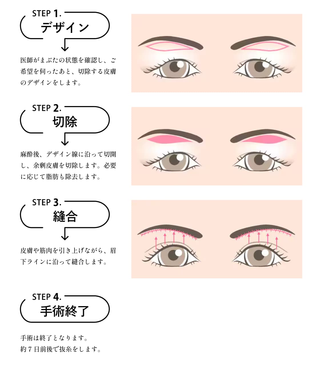 まぶたのたるみを取る施術
