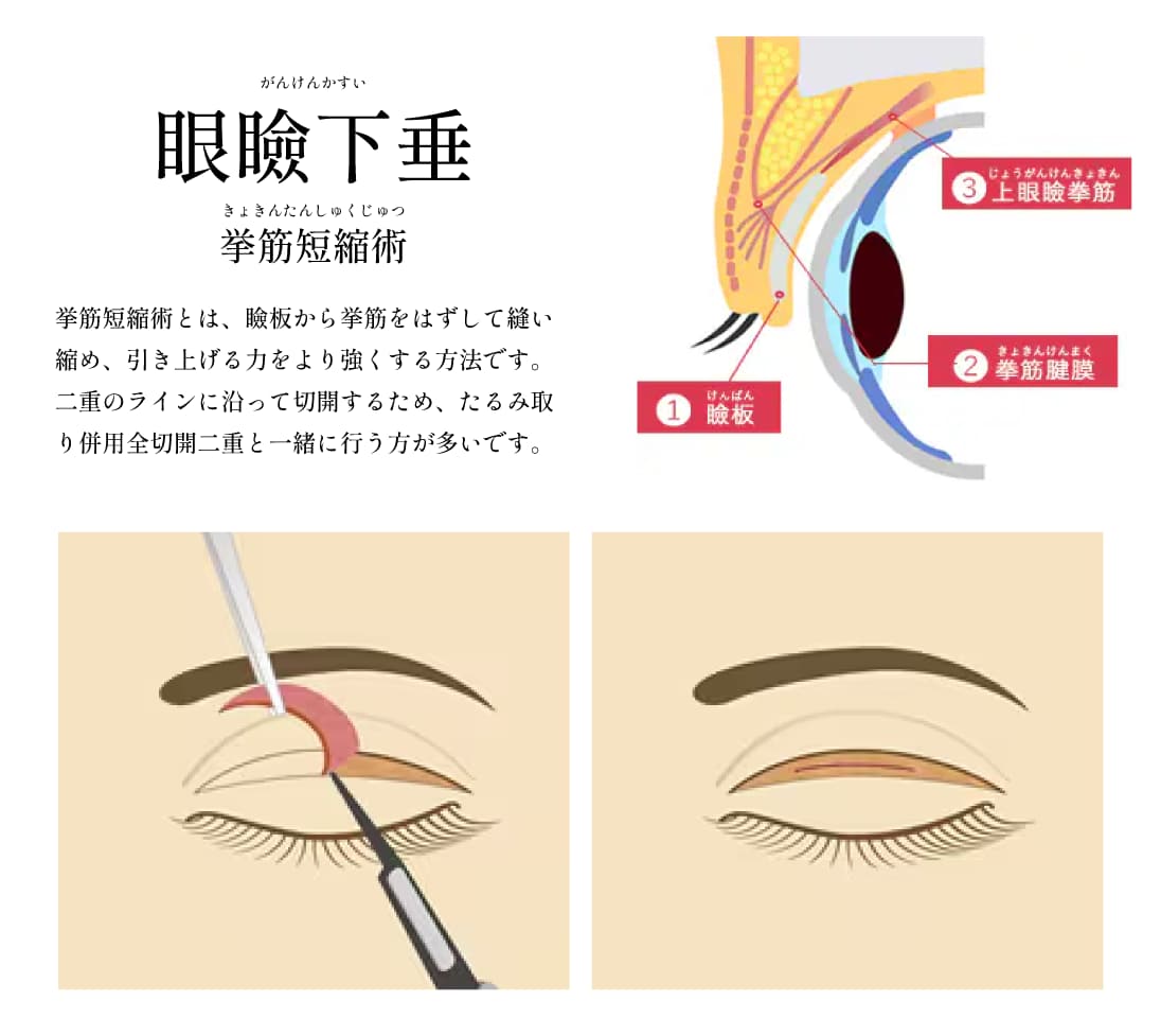 目の開きをよくする施術