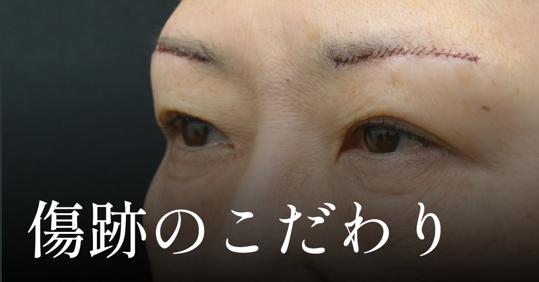 半永久の施術だから