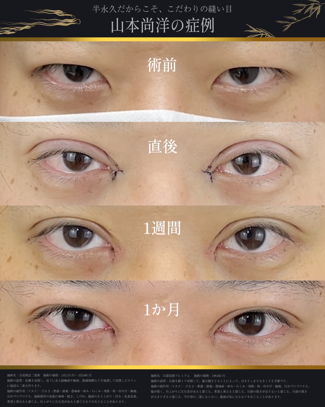 全切開二重のダウンタイム
