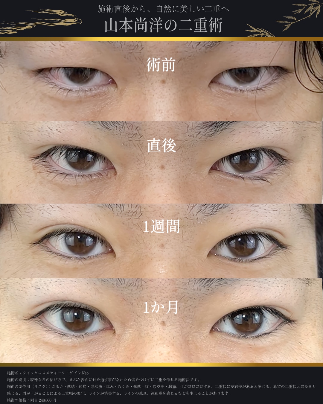 埋没法のダウンタイム