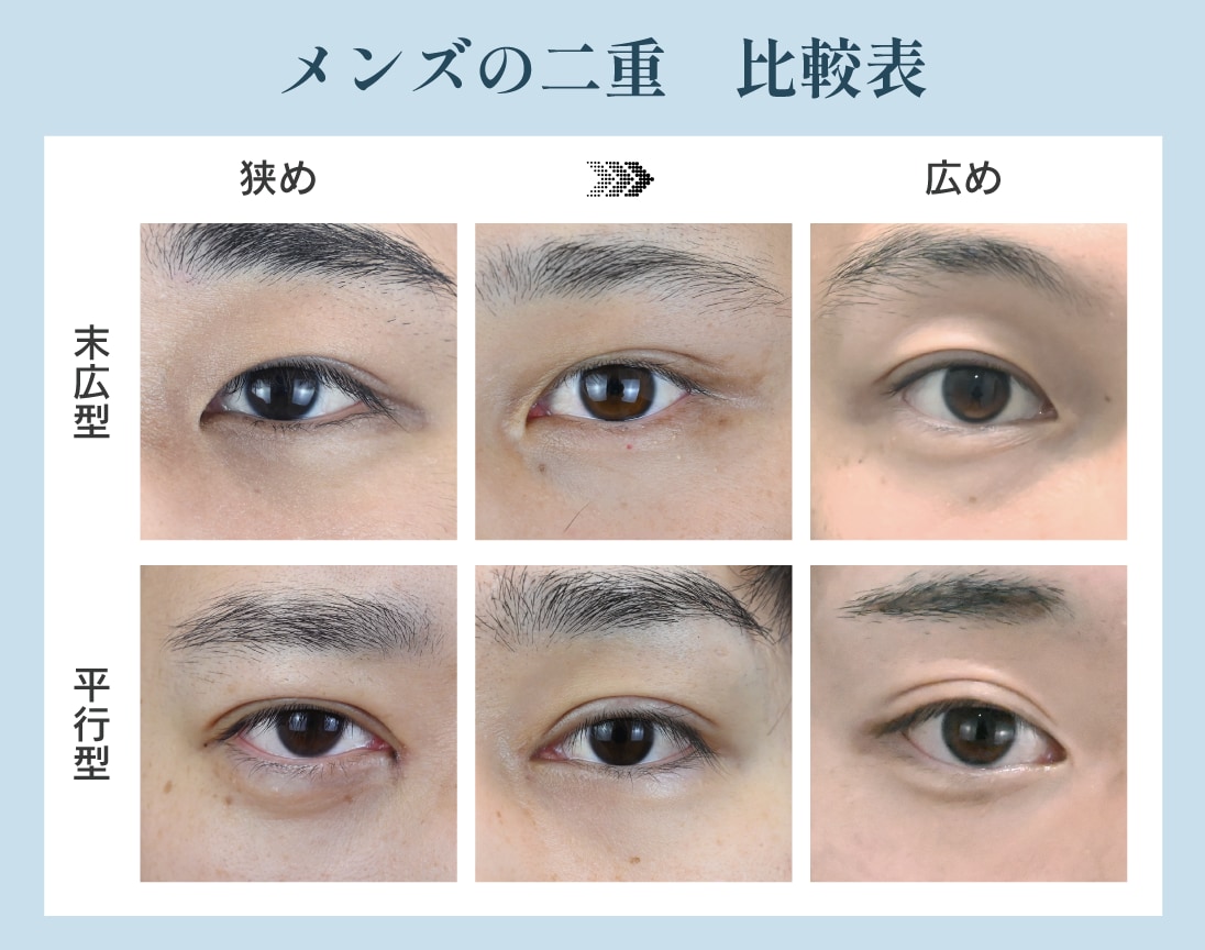 表で分かる二重の種類