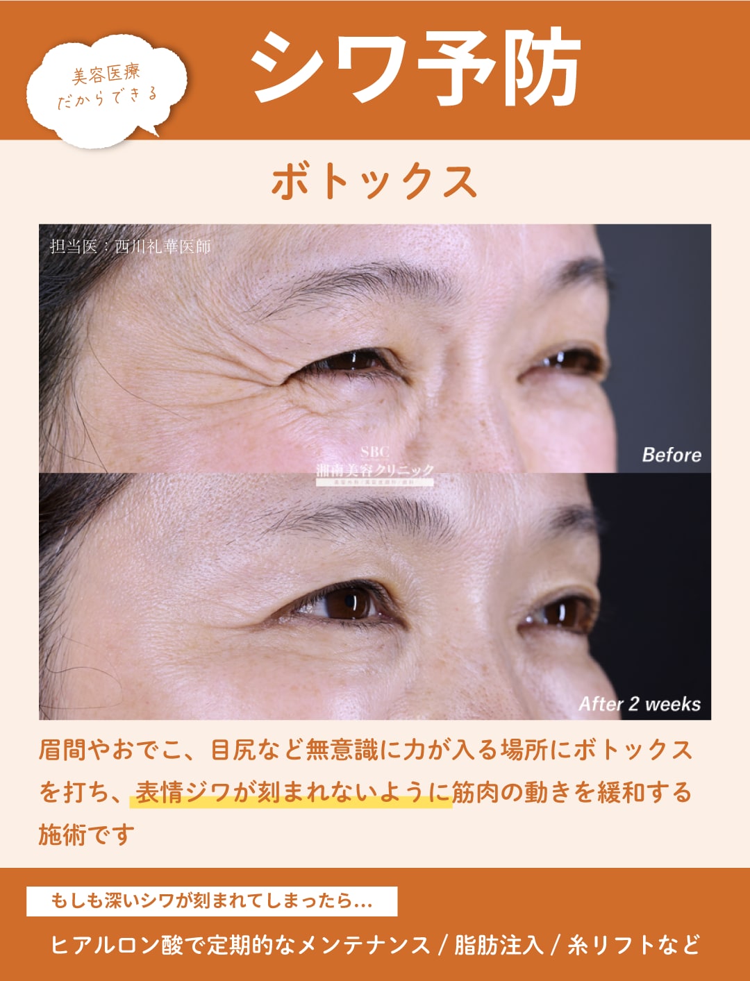 シワ予防