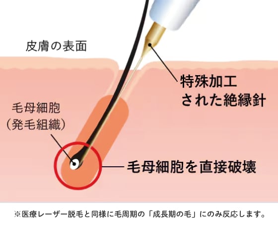 発毛組織を直接破壊する脱毛