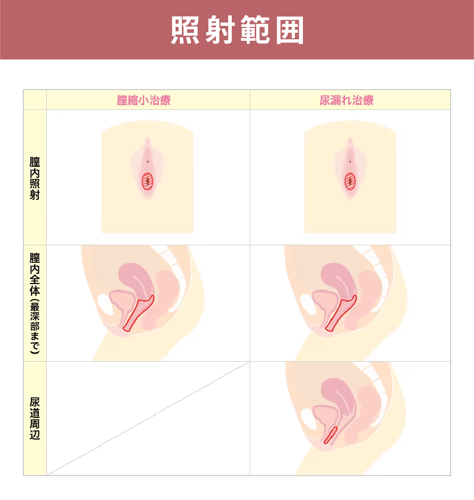 引き締めレーザーの照射範囲