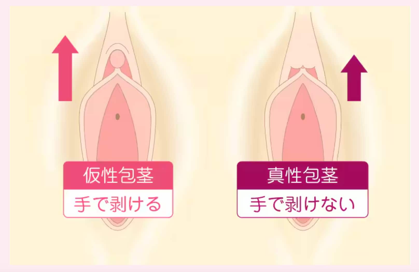 不感症の原因、実はクリトリス包茎？症状と治療法を専門医が解説 - 銀座一丁目院