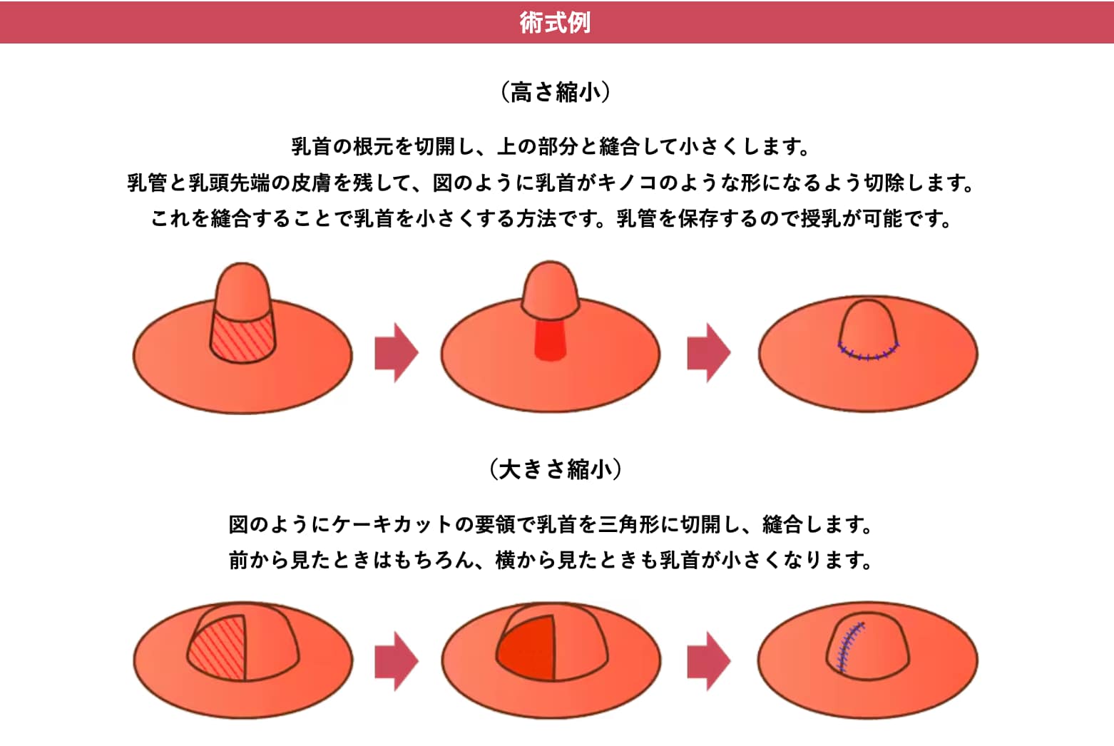 どこを切除するの？術式解説