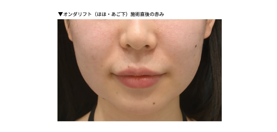 施術直後の状態